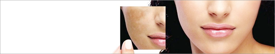 PIGMENTATION